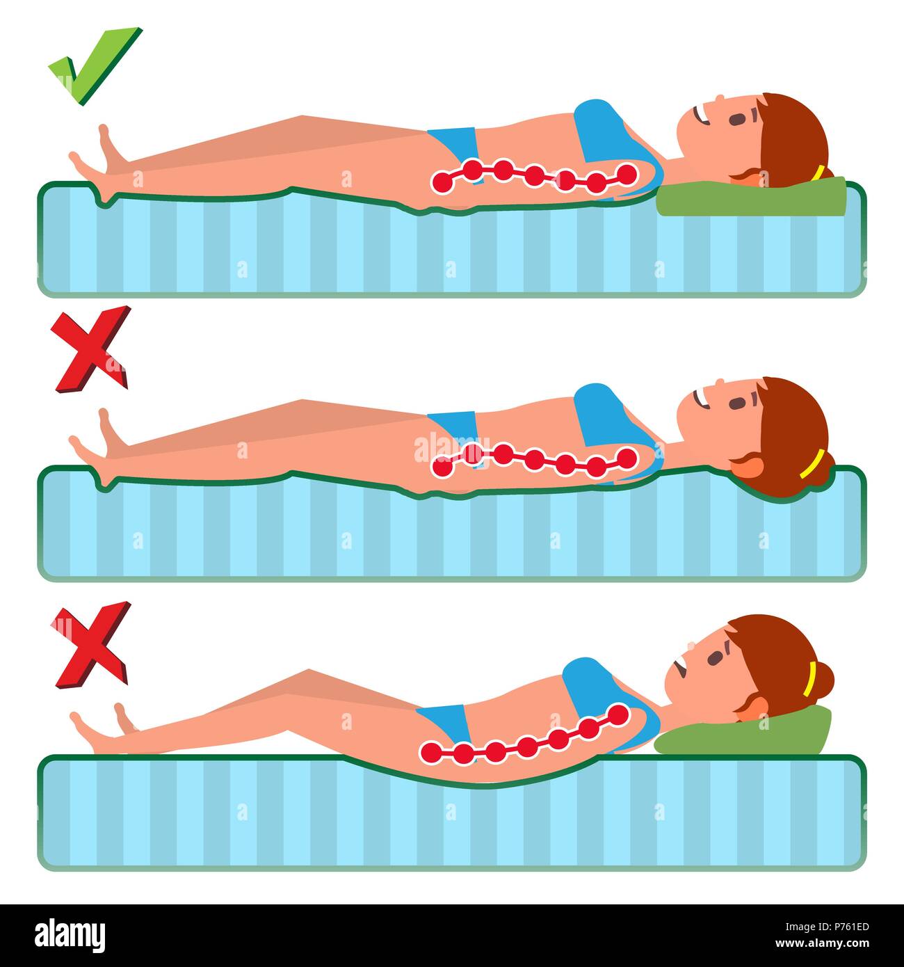 Kyphosis Stock Photos & Kyphosis Stock Images Alamy