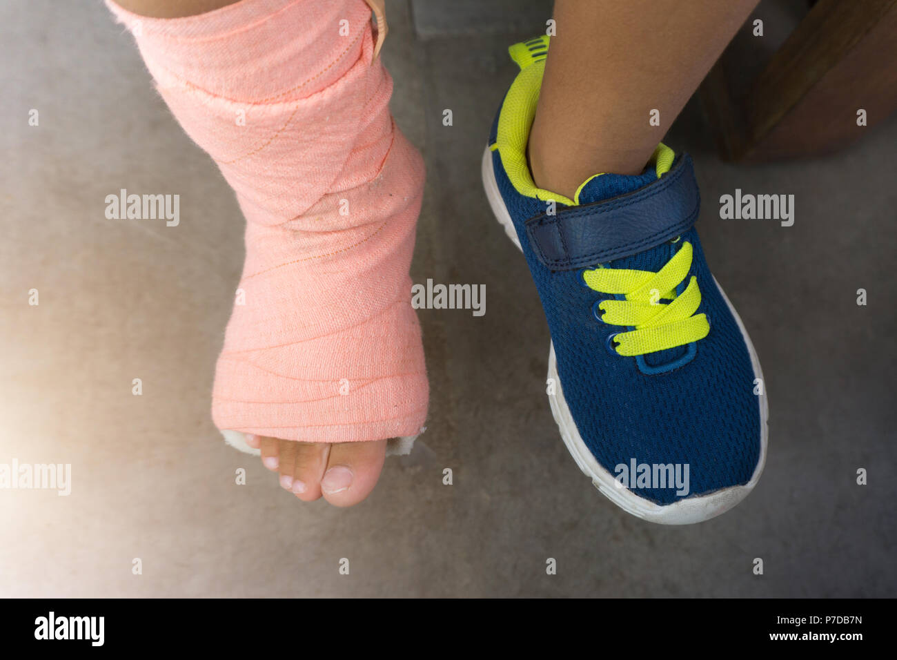 Children wearing a splint of leg broken from injury Stock Photo Alamy