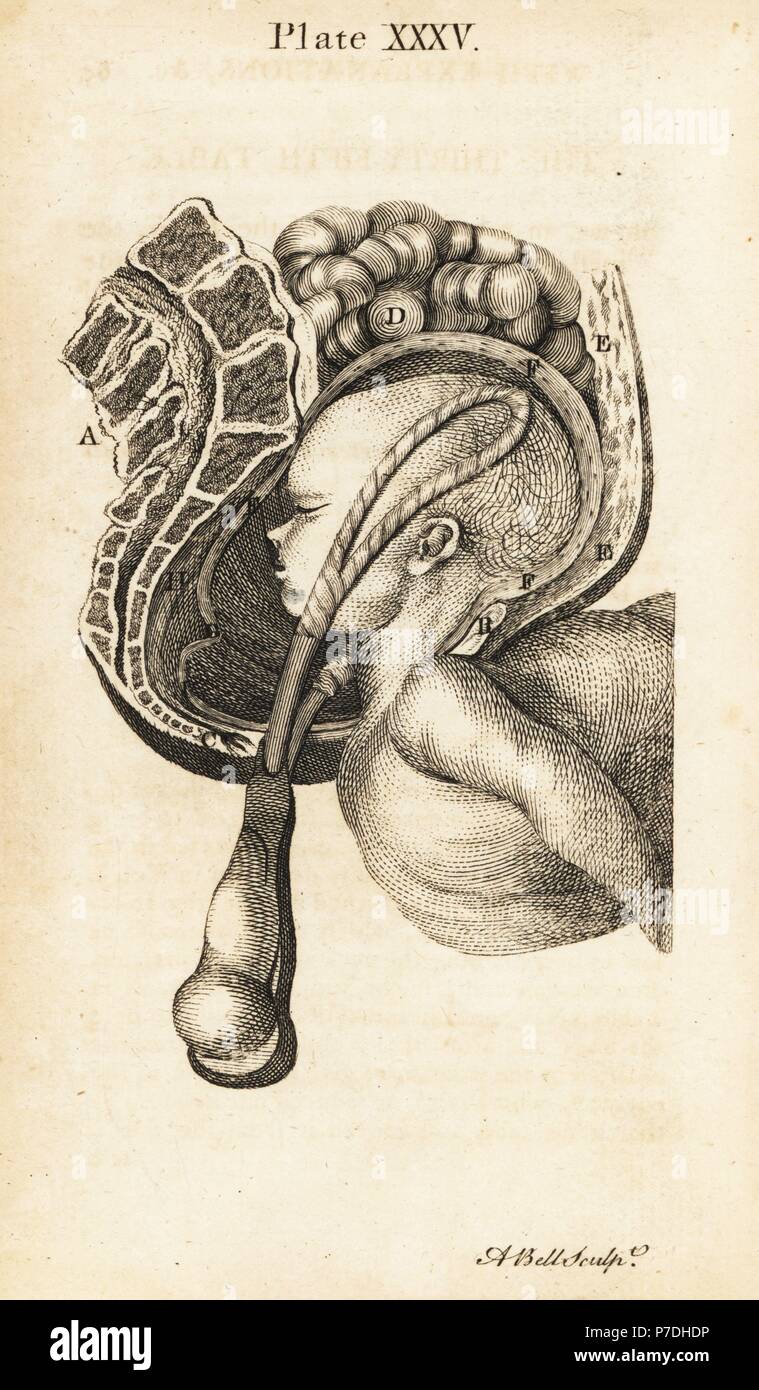Foetus head in the breech contrary position brought down the birth canal with long curved forceps. Copperplate engraving by Andrew Bell after an illustration by Jan van Rymsdyk from William Smellie's A Set of Anatomical Tables, Charles Elliot, Edinburgh, 1780. Stock Photo