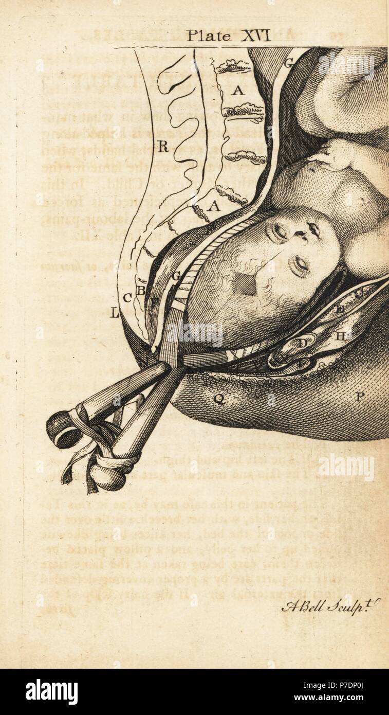 Foetus head helped through the birth canal with forceps. Copperplate engraving by Andrew Bell after an illustration by Jan van Rymsdyk from William Smellie's A Set of Anatomical Tables, Charles Elliot, Edinburgh, 1780. Stock Photo