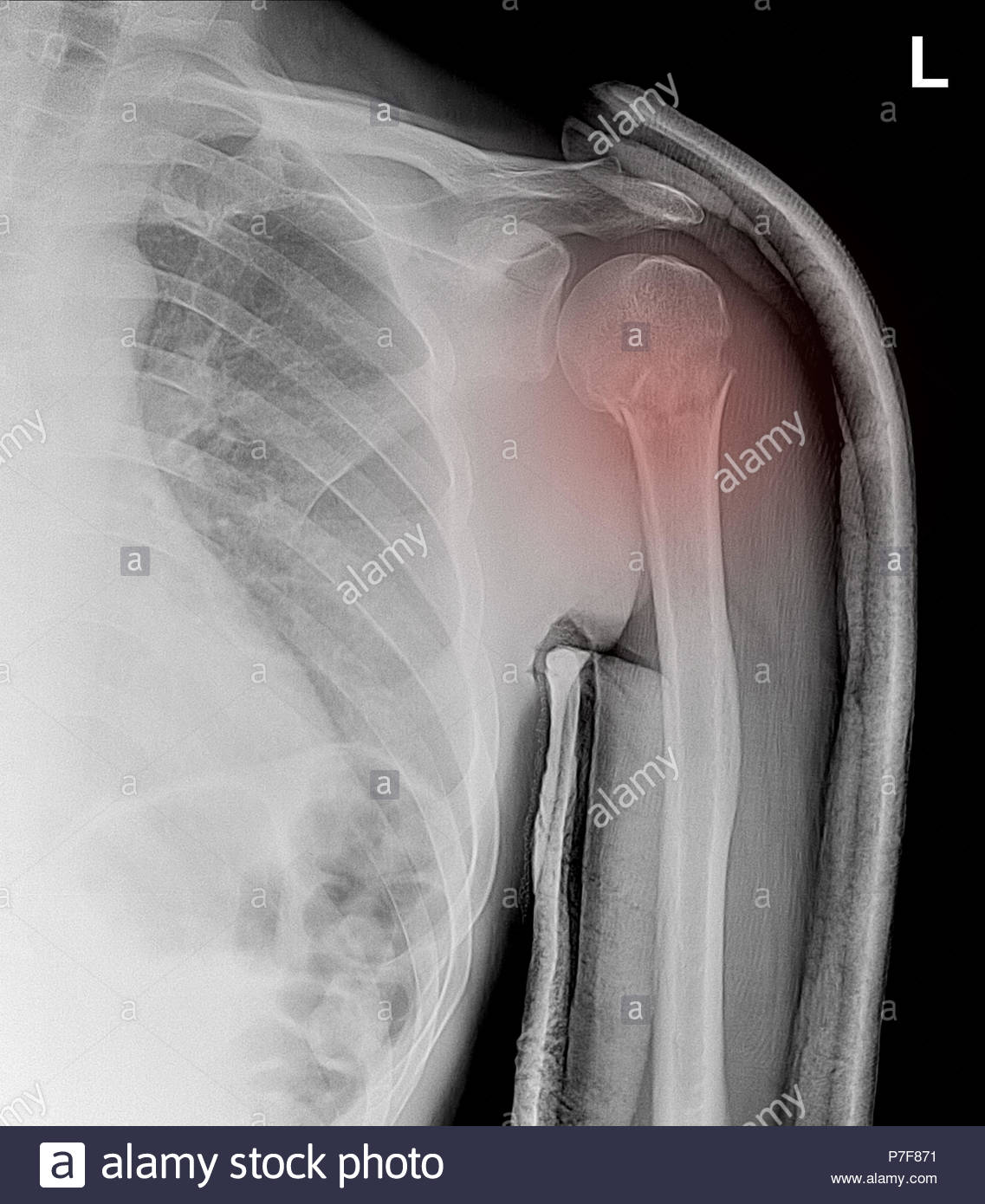 Humerus Bone Stock Photos & Humerus Bone Stock Images Alamy