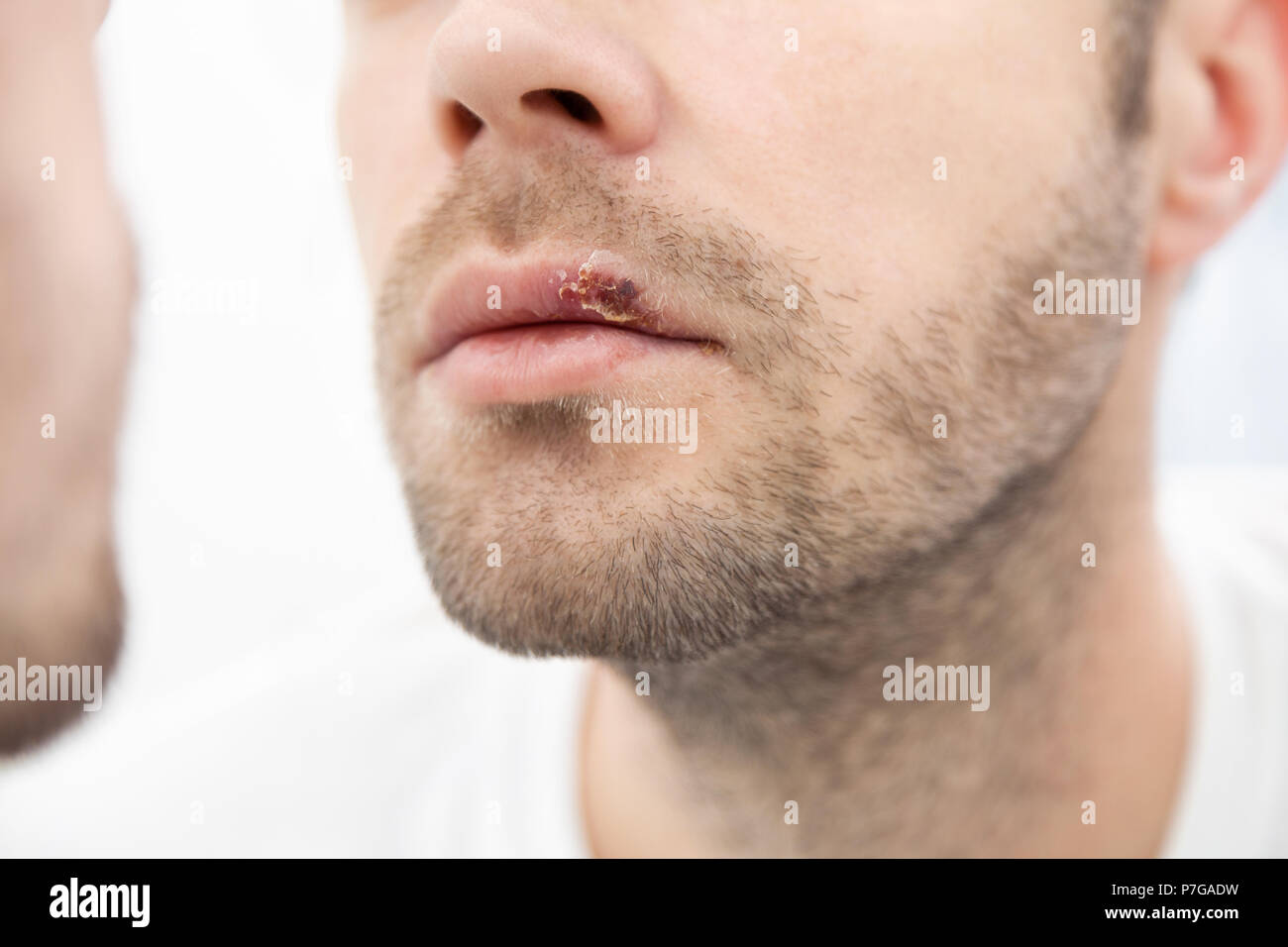 Young man suffering from painful herpes on his mouth Stock Photo Alamy