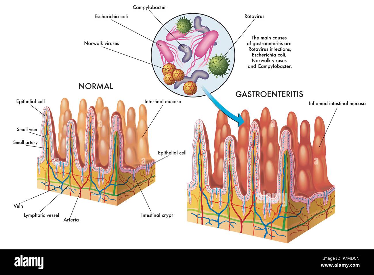 Gastroenteritis Treatment Gastroenteritis Treatment