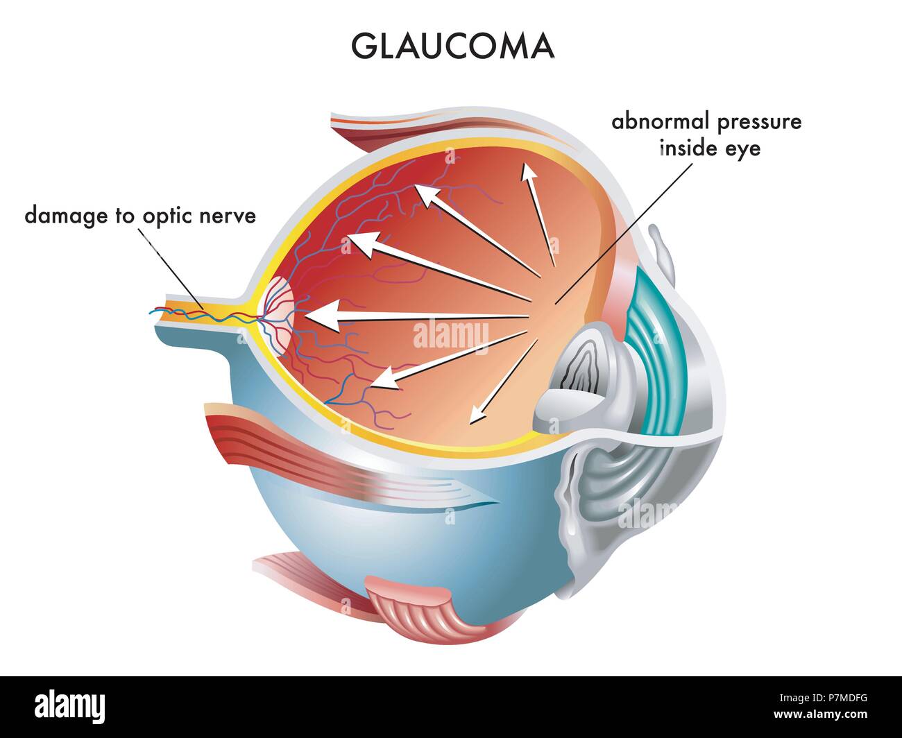 vector medical illustration of the causes of glaucoma Stock Vector