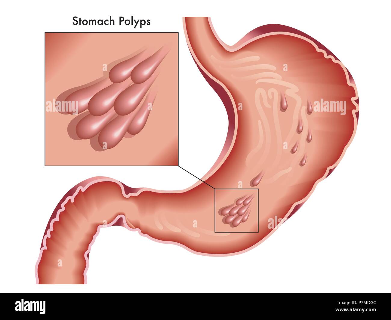 Illustrated medical drawing of stomach with polyps. Stock Vector