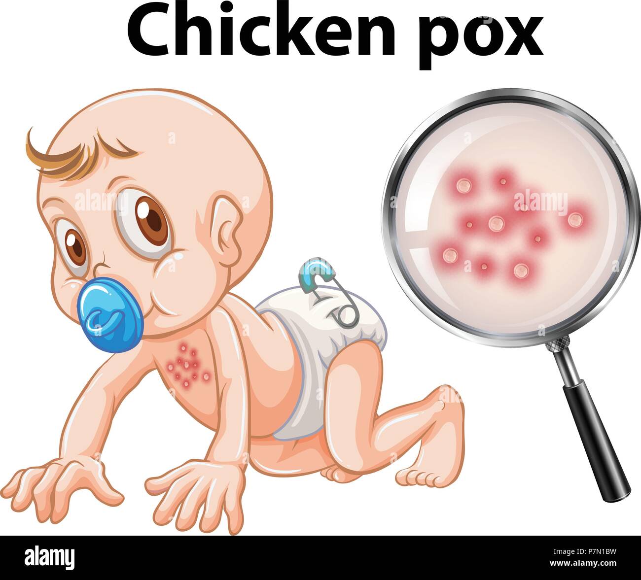 A Baby with Chicken Pox illustration Stock Vector Image & Art - Alamy