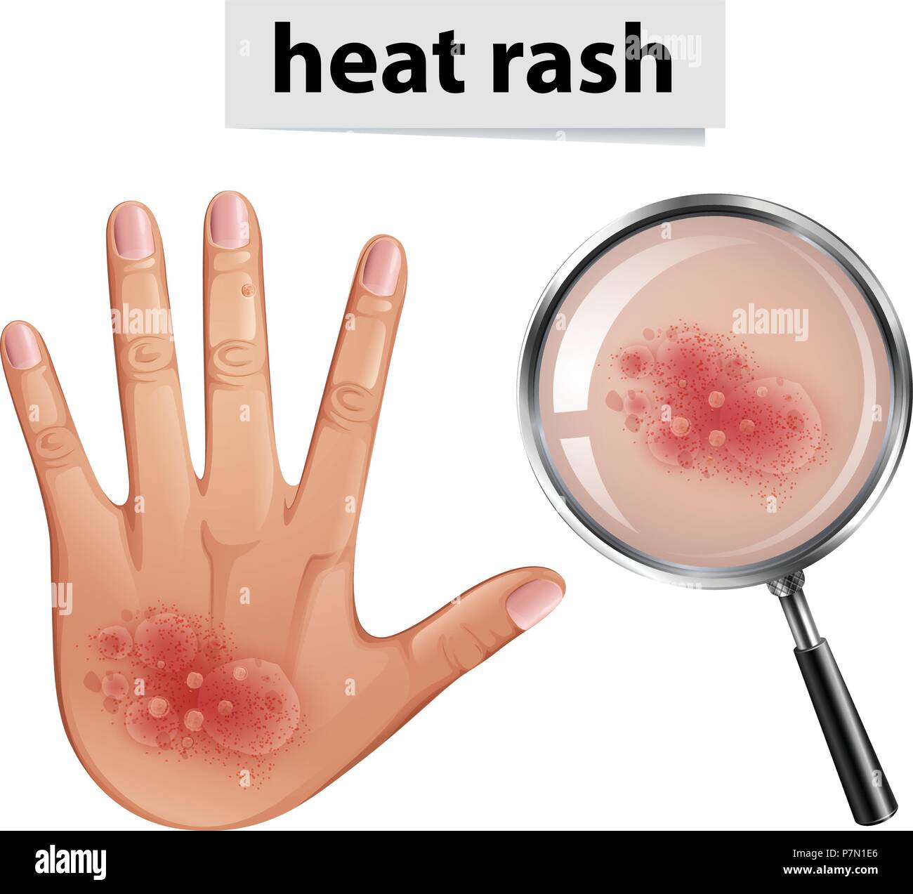 Human Hand with Heat Rash illustration Stock Vector