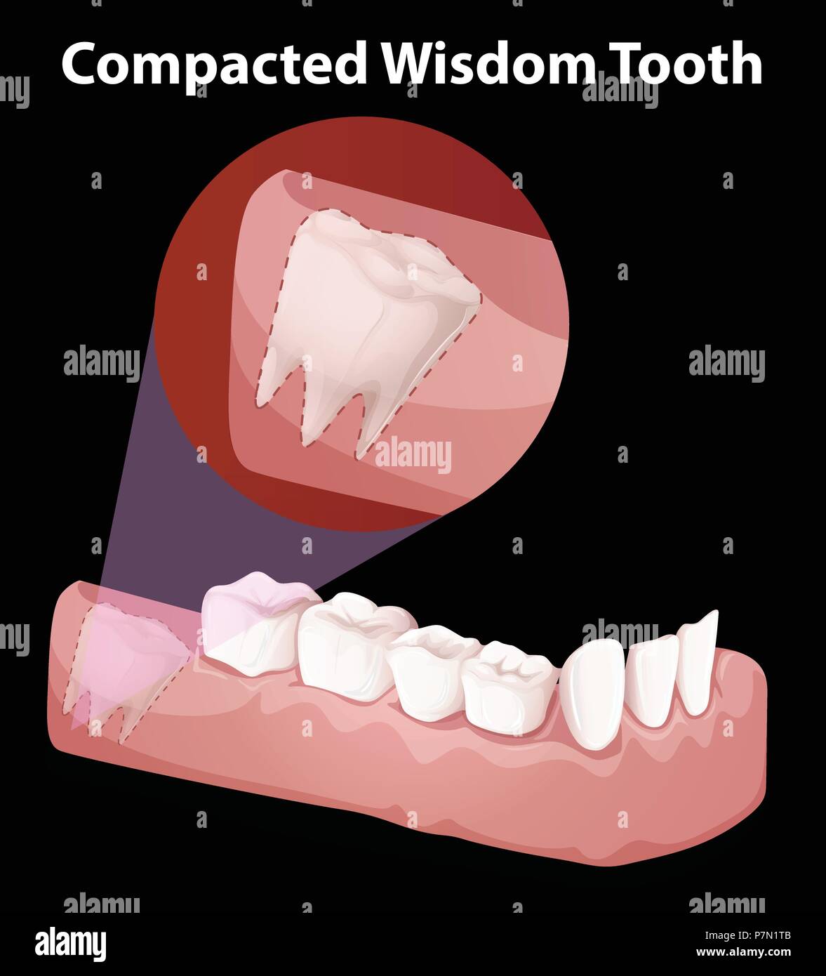 Compacted Wisdom Tooth Diagram illustration Stock Vector Image & Art Alamy