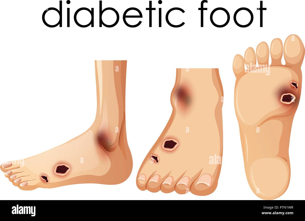 Human Foot with Diabetic  illustration Stock Vector