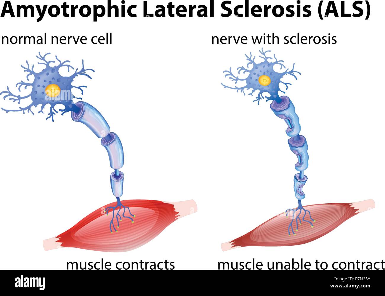 Amyotrophic lateral sclerosis concept illustration Stock Vector Image
