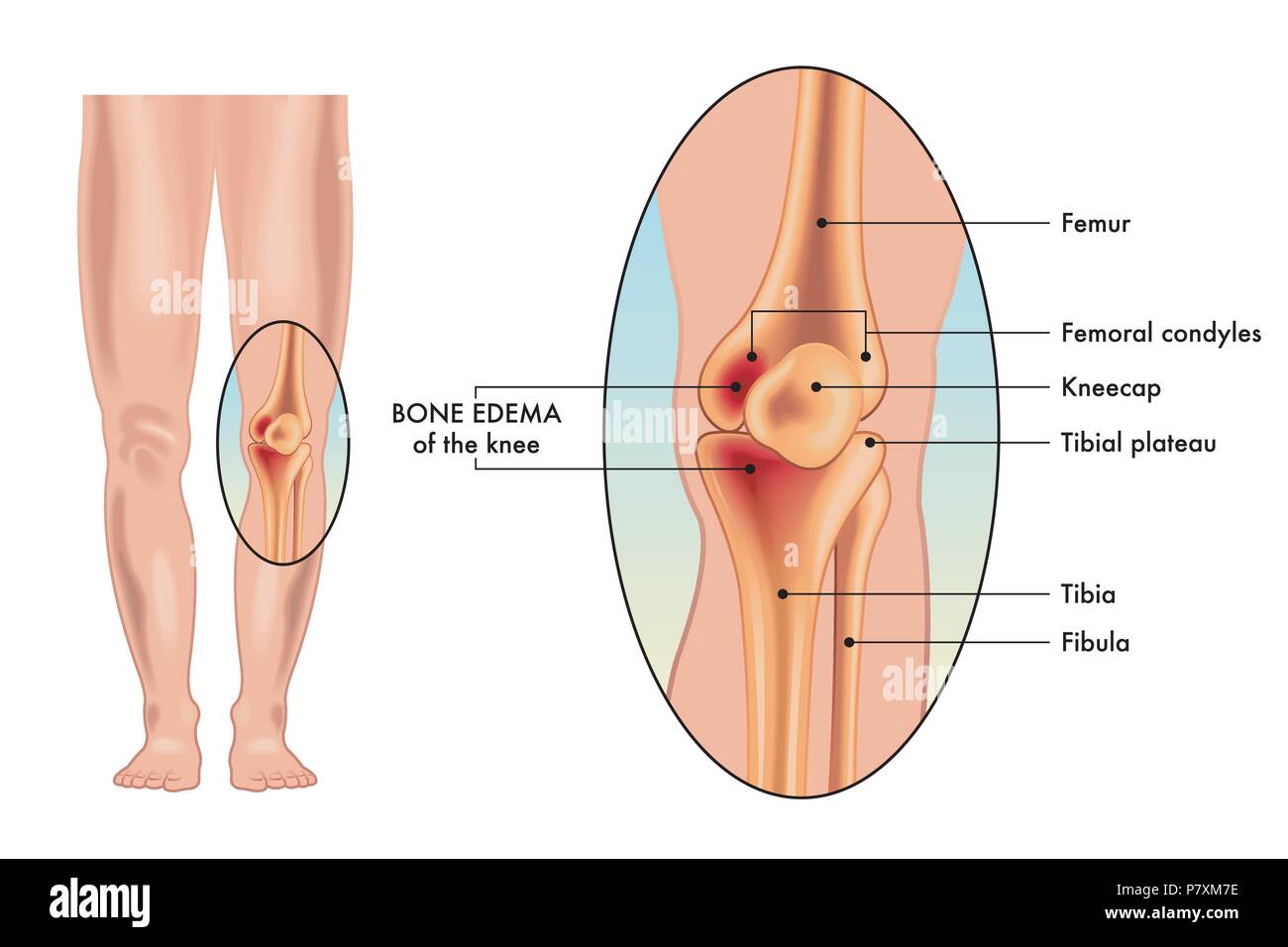 A vector medical illustration of the symptoms of a bone edema on a knee. Stock Vector