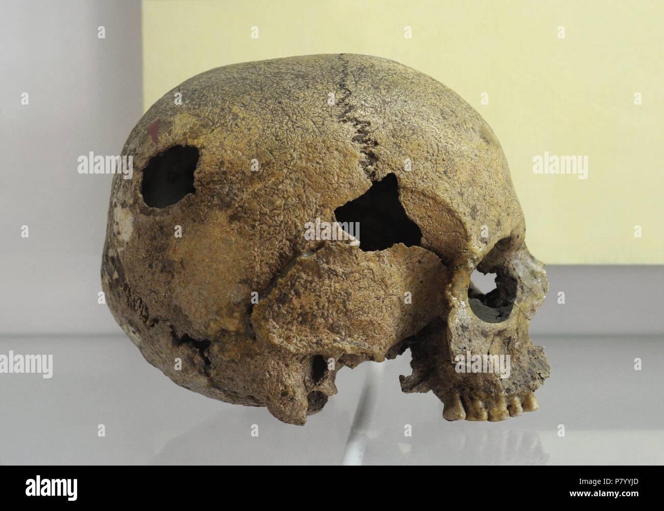 Poland. Prehistory. Human skull marked with post-trephination hole. It is presented in a permanent exhibition 'Disease prehistoric population on Polish soil'. Archaeological Museum. Gdansk. Poland. Stock Photo