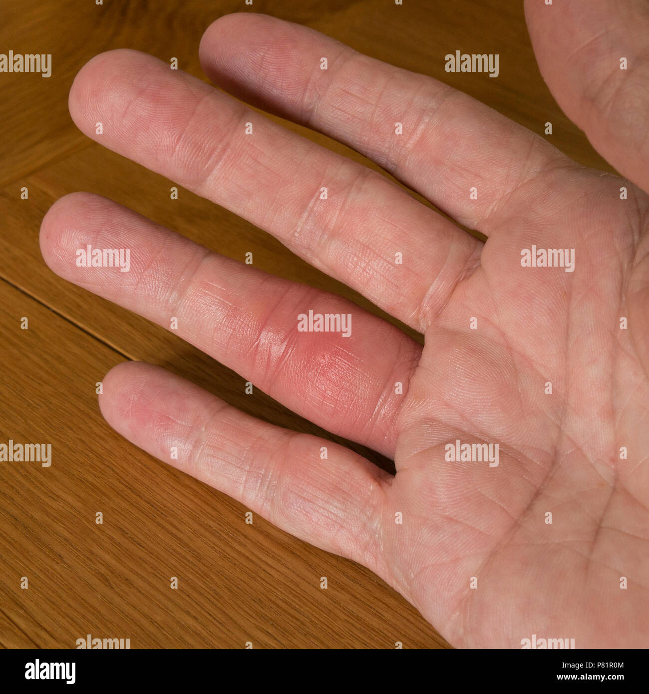 Swollen red finger on hand following insect bite Stock Photo