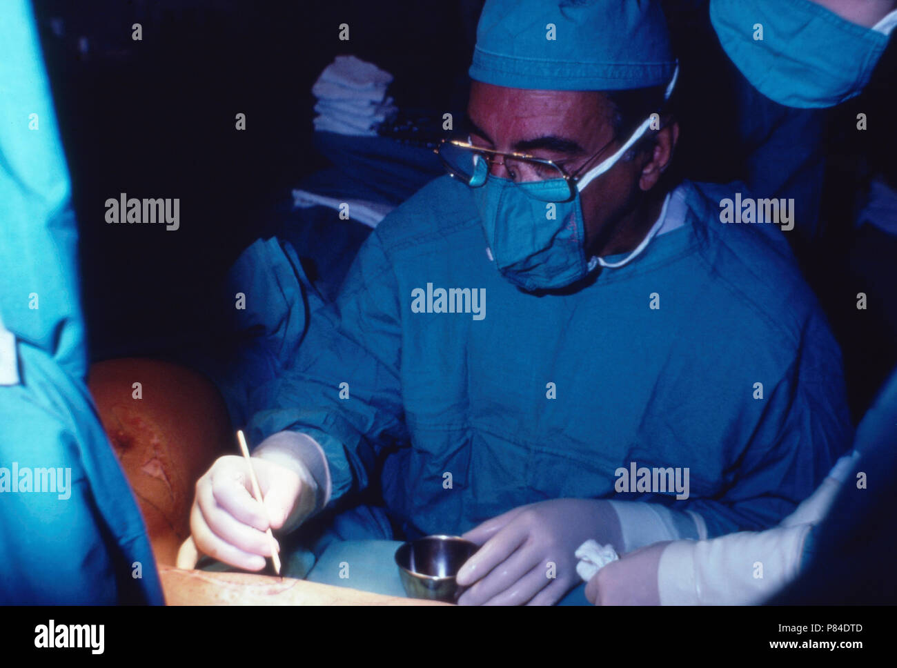 Der südafrikanische Herzchirurg Professor Christiaan Barnard bei einer Operation in Kapstadt, Südafrika 1970er Jahre. South African cardiac surgeon Christiaan Barnard during a surgery at Cape Town, South Africa 1970s. Stock Photo
