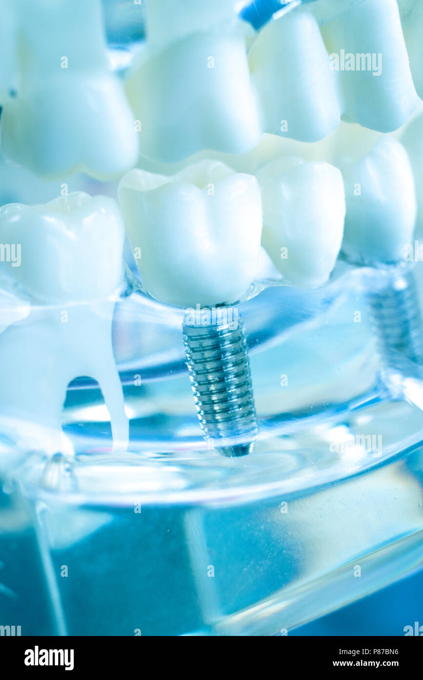 Dentist dental teeth teaching model showing titanium metal tooth