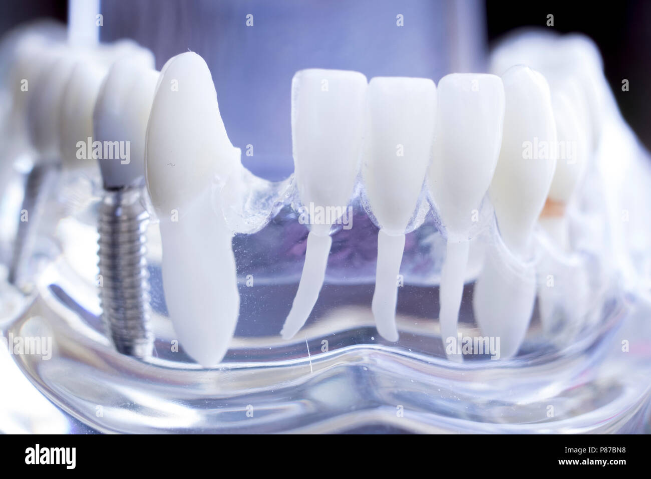 Dentist dental teeth teaching model showing titanium metal tooth