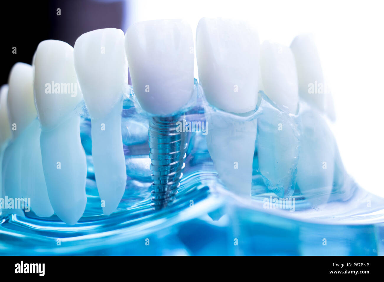 Dentist dental teeth teaching model showing titanium metal tooth