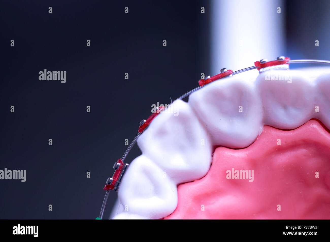 Dental metal braces teeth retainer aligners teaching orthodontics model