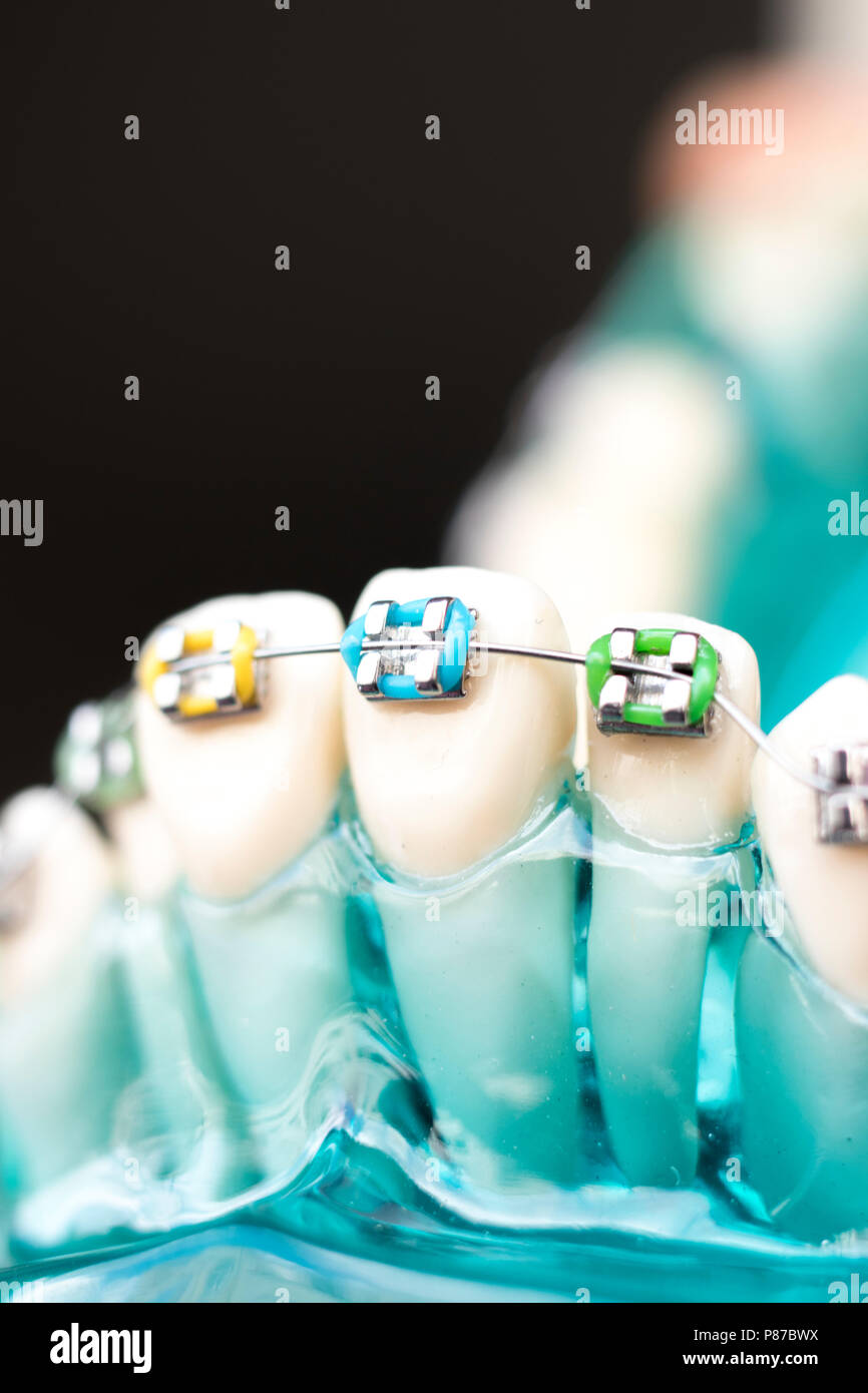 Dental metal braces teeth retainer aligners teaching orthodontics model ...