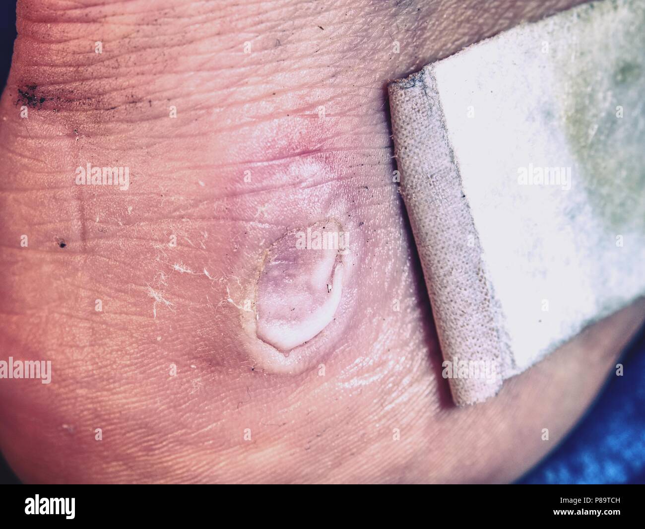 The bandaid on the blister on hurt leg. Sportsman's heel with blister