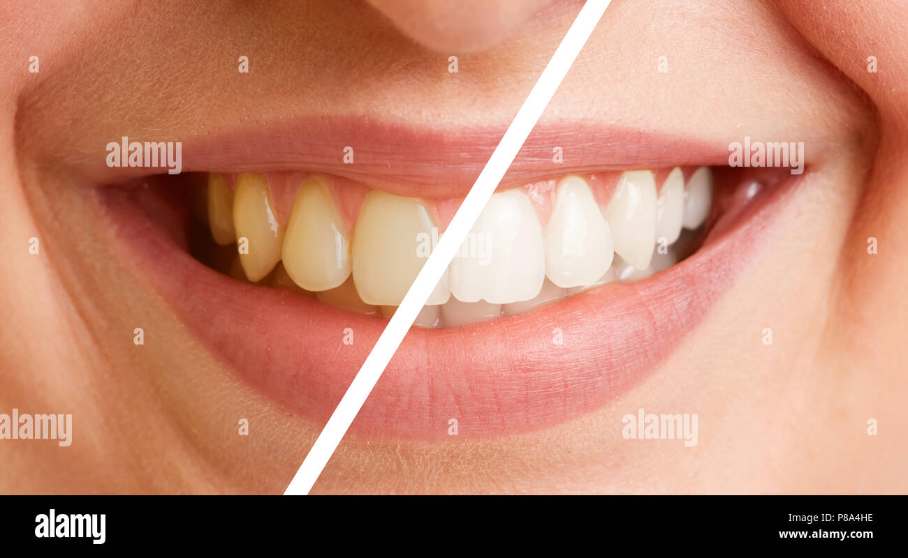 Comparison of teeth of a young woman before and after a tooth cleaning Stock Photo