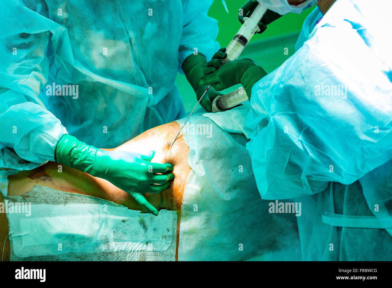 cosmetic liposuction surgery in actual operating room setting showing