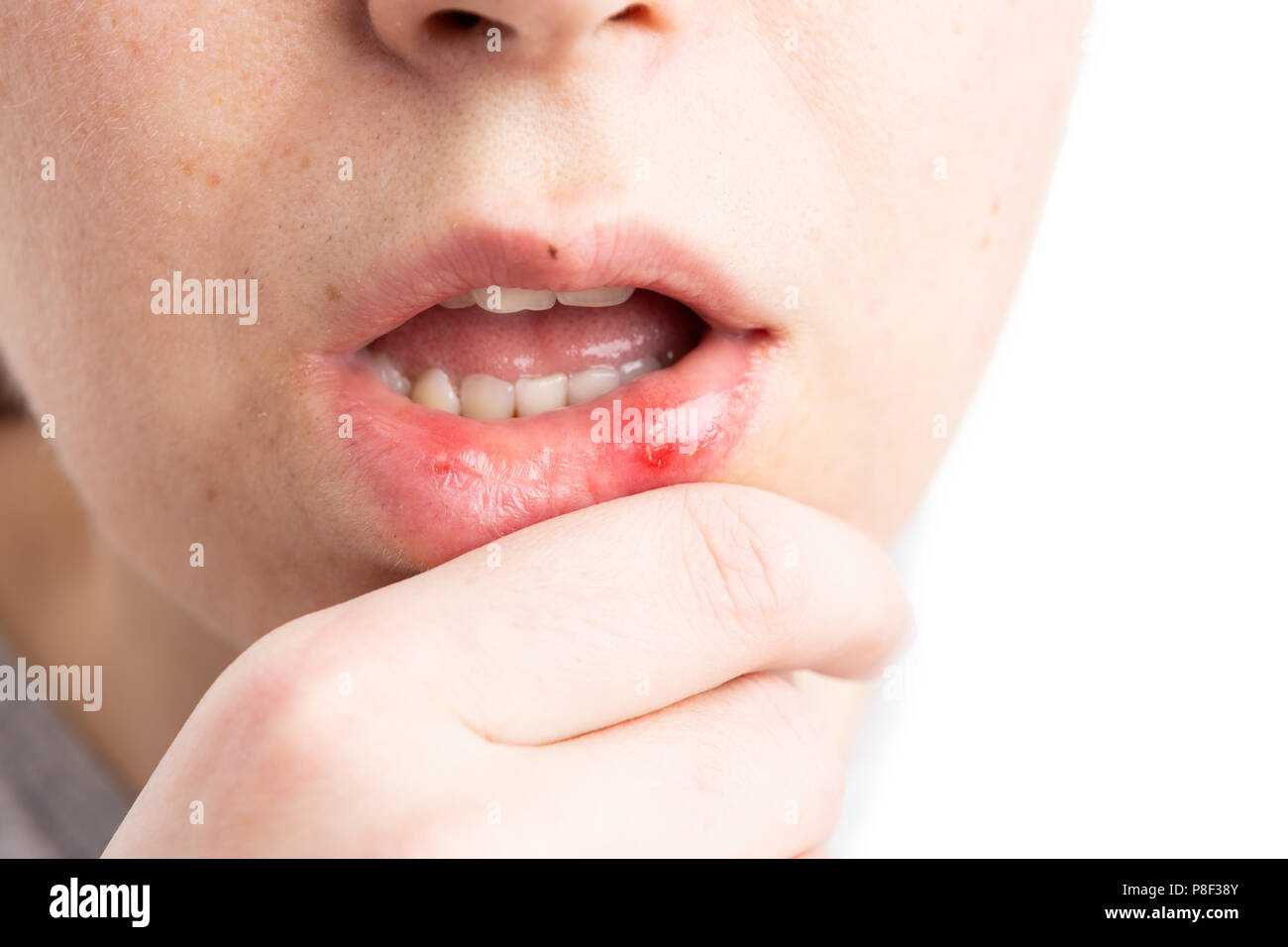 Aphtha on woman lower lip as medical discomfort or female stomatitis concept Stock Photo