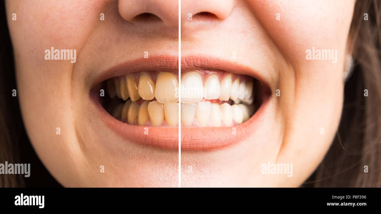 Before and after teeth whitening concept with woman denture yellow and white Stock Photo