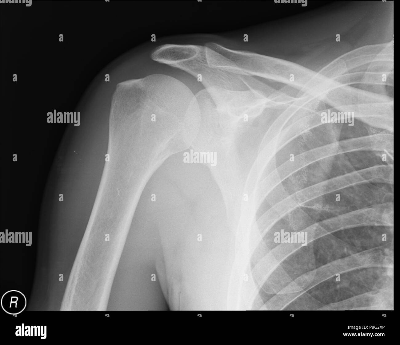 X-ray. Shoulder radiograph. AP view. No visible pathologic changes in bone structures. No calcification in the rotator cuf. Effects of pleurectomy. Stock Photo