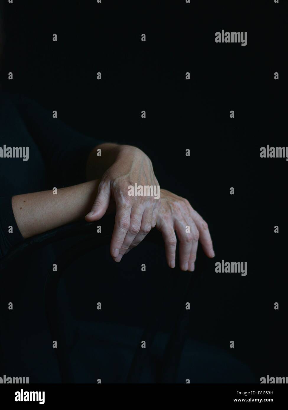 vitiligo cosmetic defekt Stock Photo Alamy