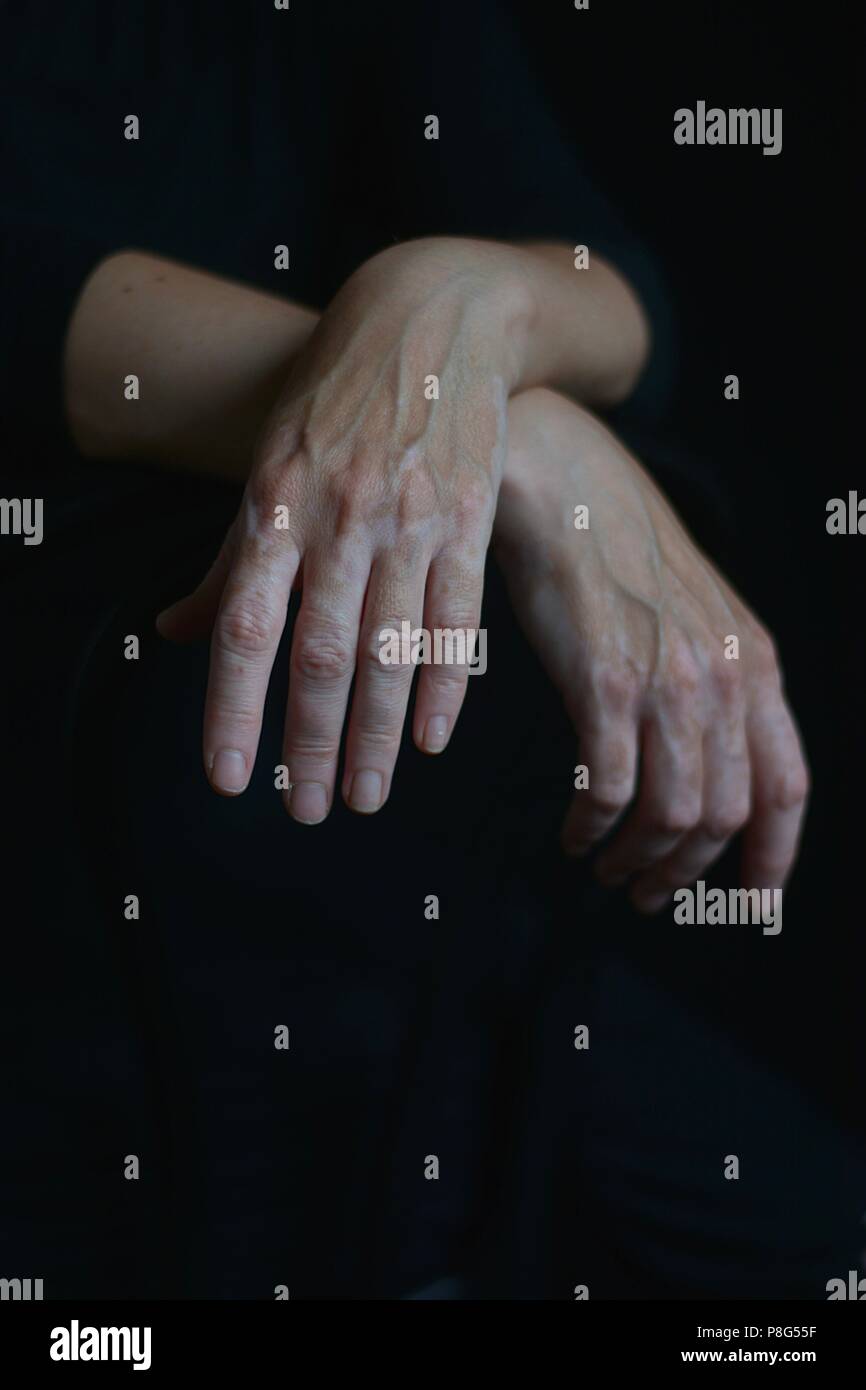 vitiligo cosmetic defekt Stock Photo Alamy