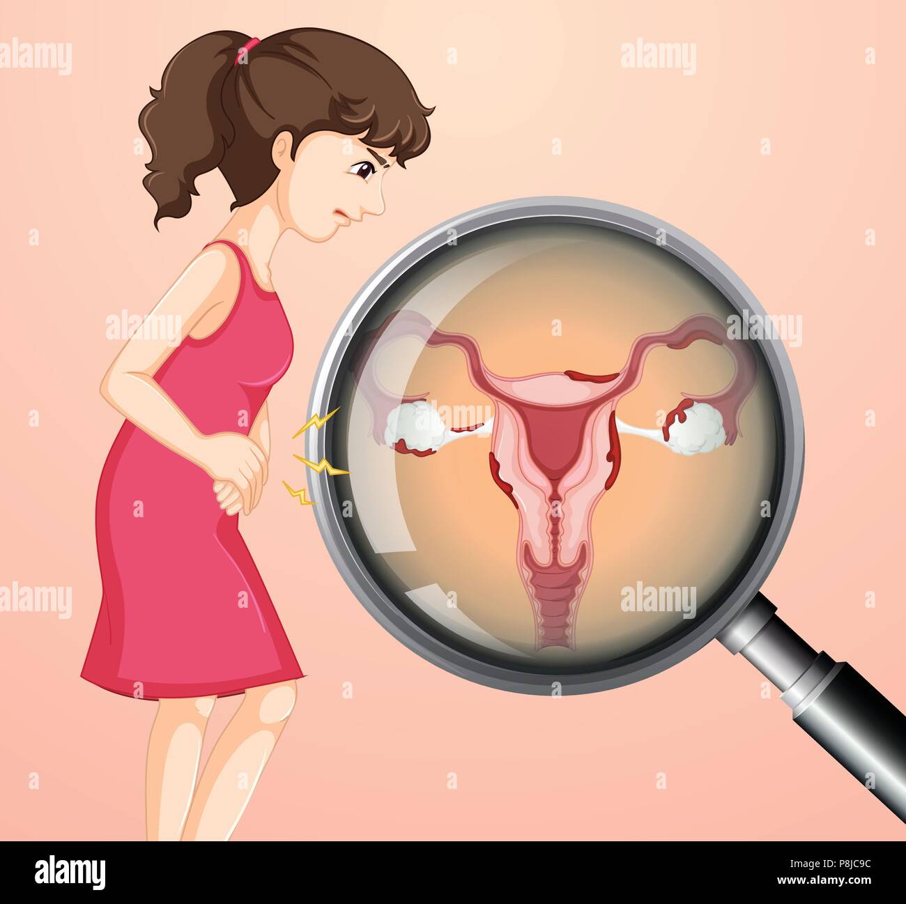 Woman with Ovarian Cancer  illustration Stock Vector