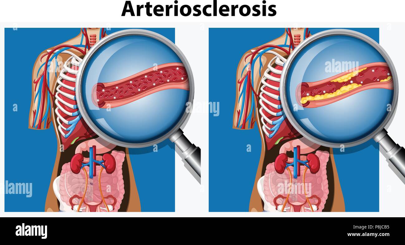 Human Anatomy with Arteriosclerosis illustration Stock Vector Image & Art -  Alamy