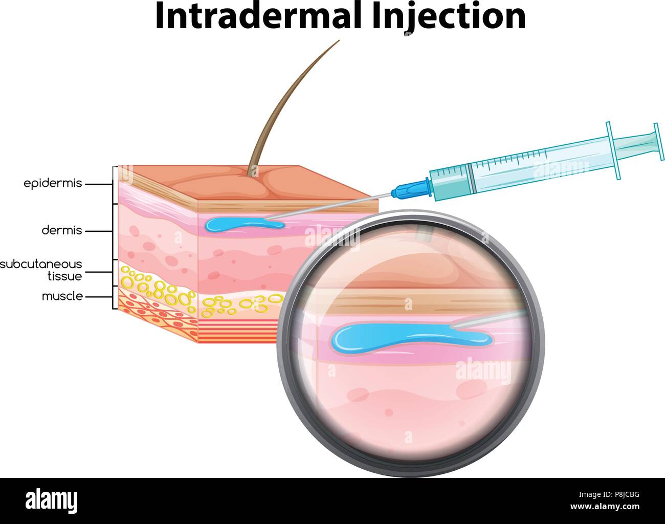 intradermal injection