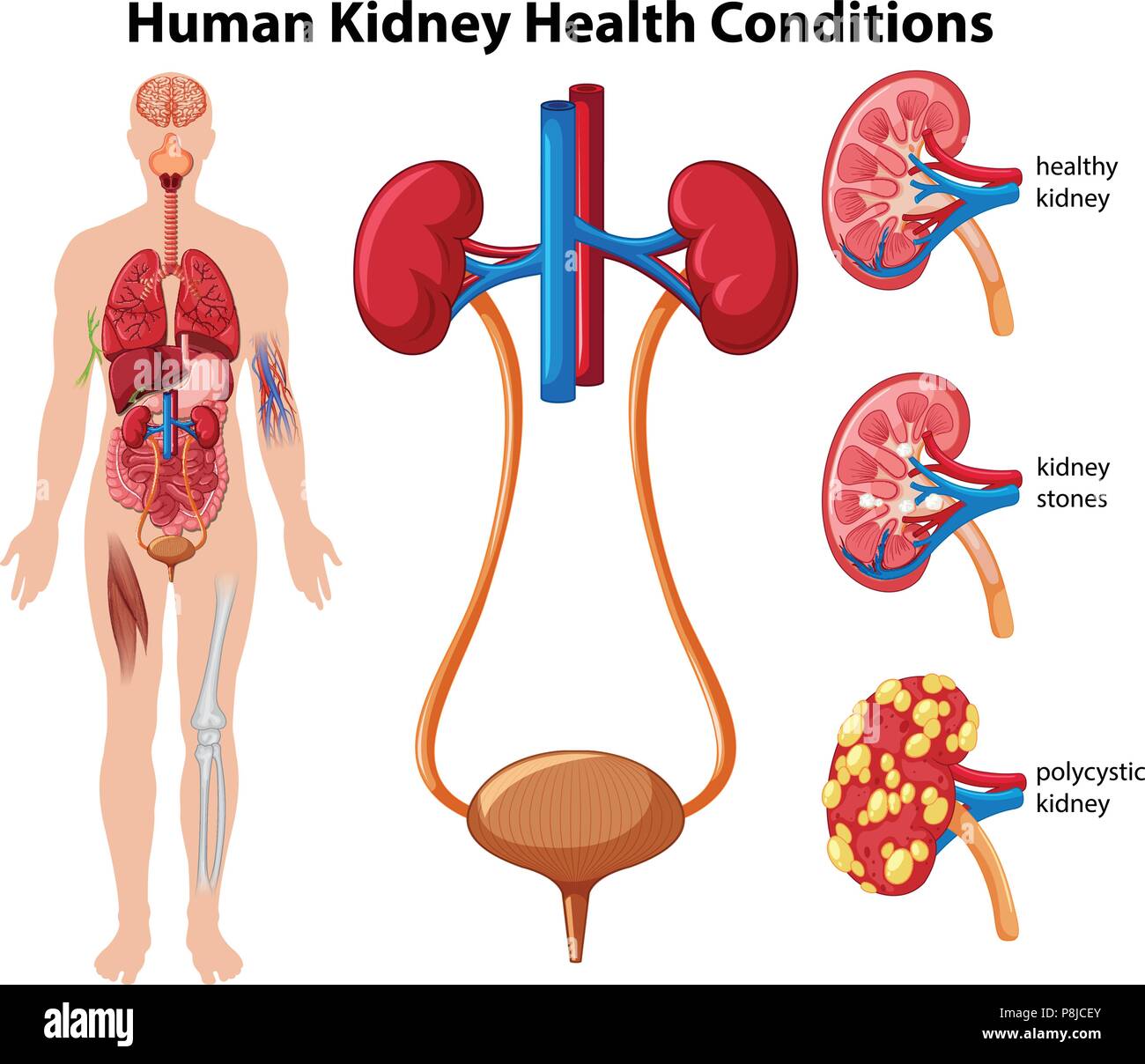 Human Kidney Health Conditions illustration Stock Vector Image & Art ...
