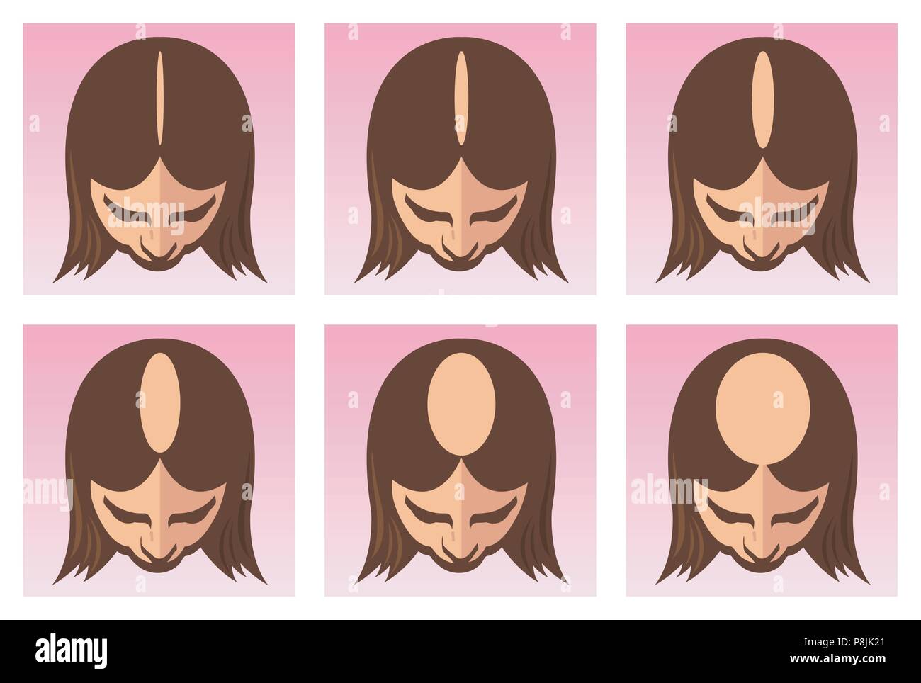 A vector medical illustration of the stages of female alopecia or hair loss. Stock Vector