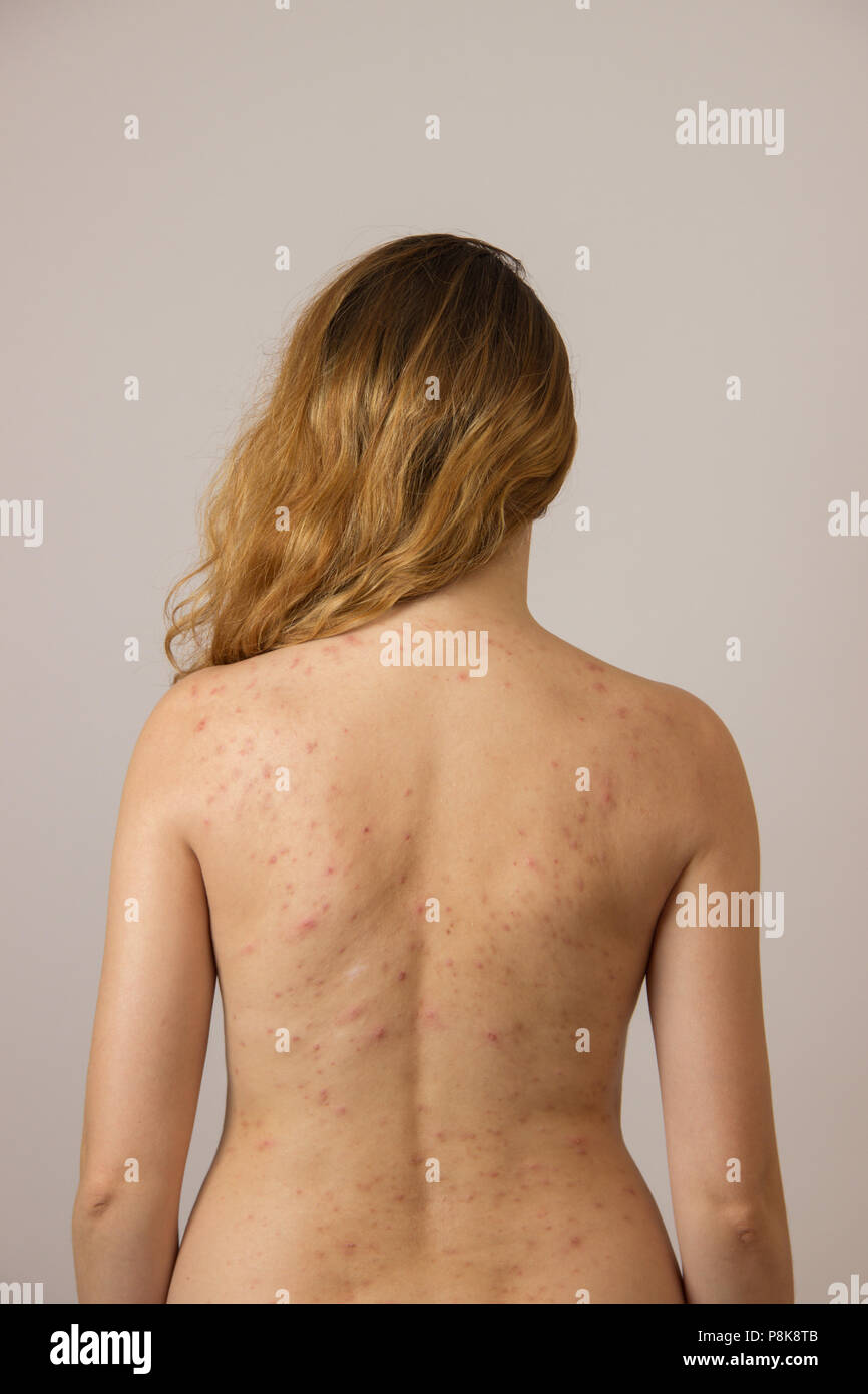 Young girl with acne, with red spots on the back Stock Photo
