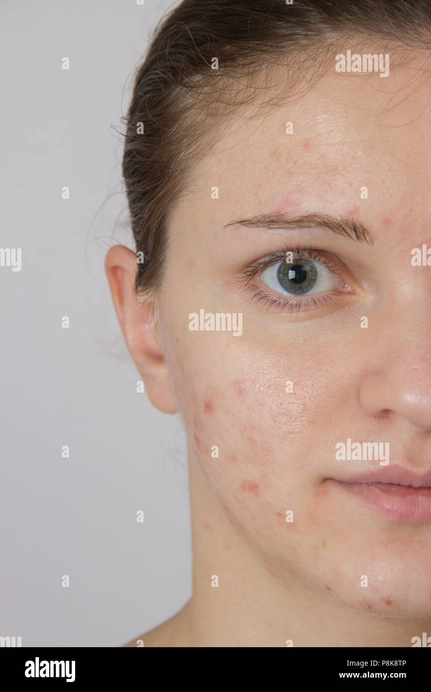 Beautiful young girl with acne on his face on a white background Stock Photo