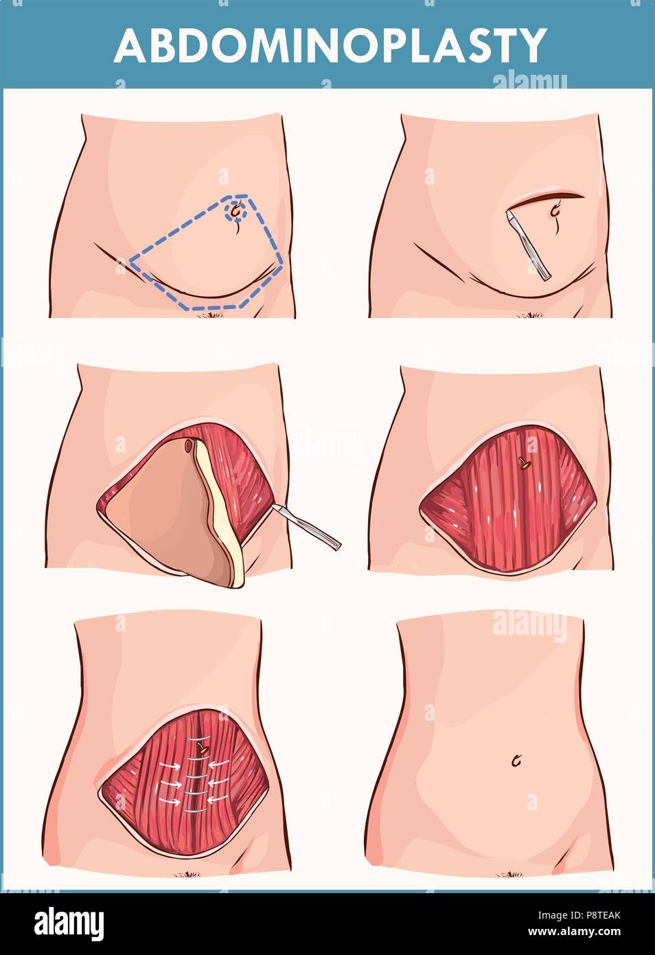 Vector illustration of a abdominoplasty and Lipectomy Procedures Stock Vector