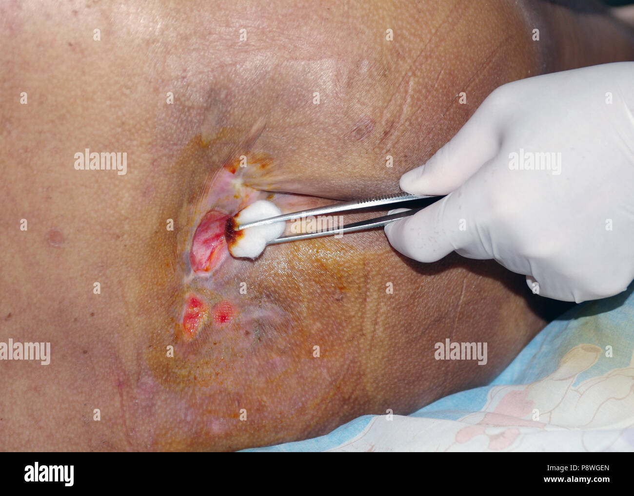 Nurse dressing Decubitus ulcer or Pressure ulcer in patient home. Stock Photo