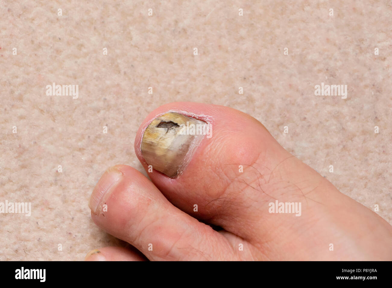 Close-up of ill male foot thumb nail, fungal nail. Stock Photo