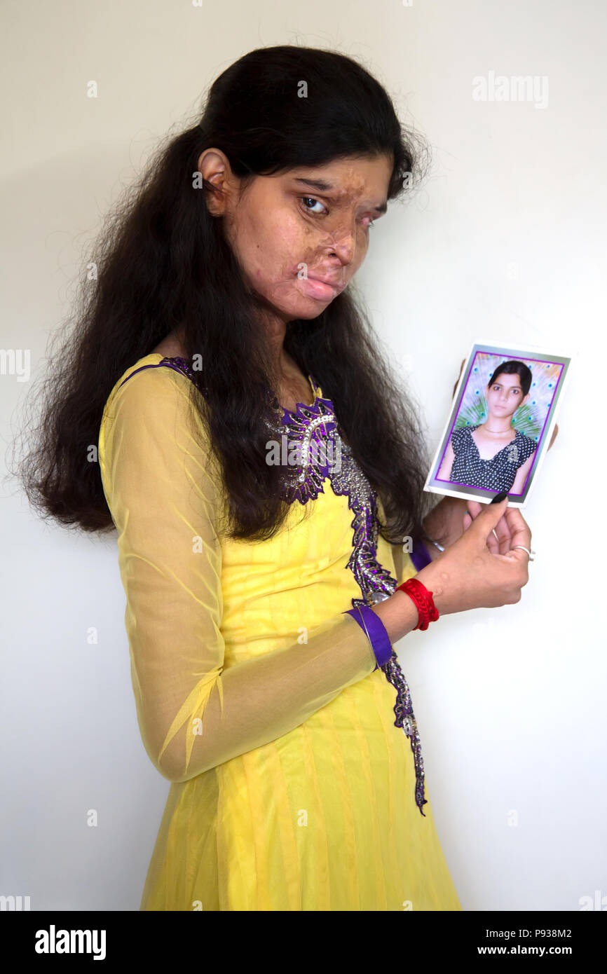 Ritu victim of Acid attack in Delhi shows a picture of herself before the attack (from Stop Acid Attacks campaign, India) Stock Photo