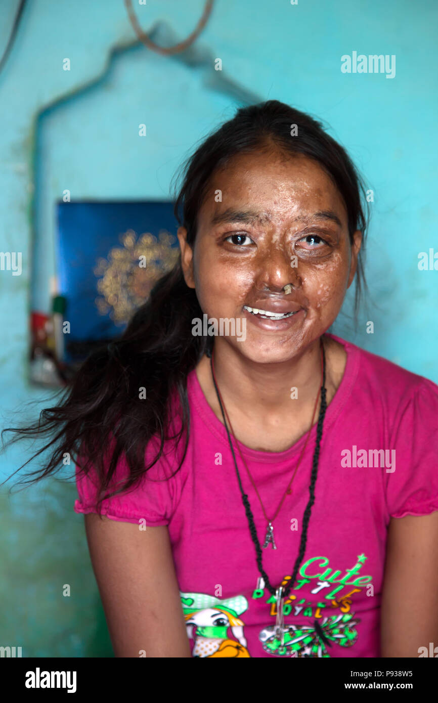 Dolly, victim of Acid attack, in her home in Agra(from Stop Acid Attacks campaign, India) Stock Photo