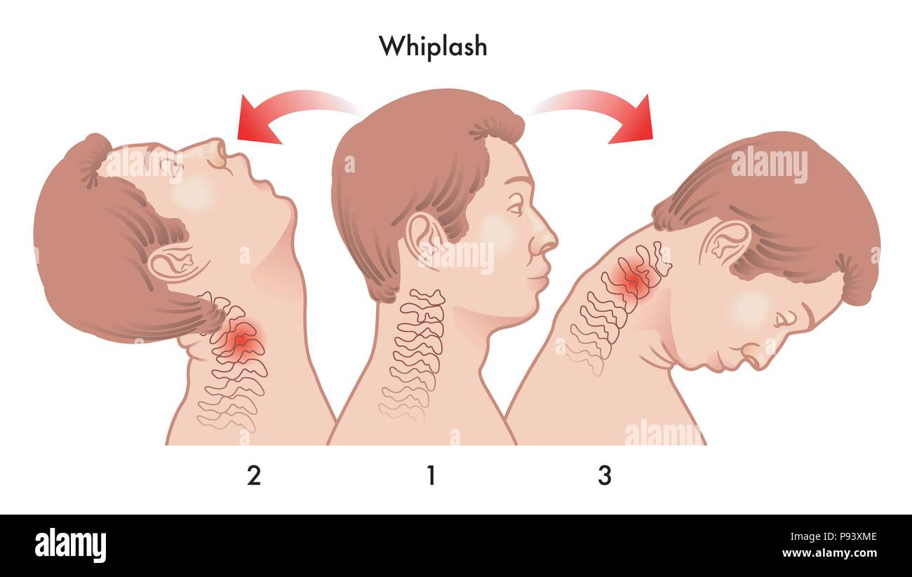 vector medical illustration of the dynamics of the whiplash injury Stock Vector