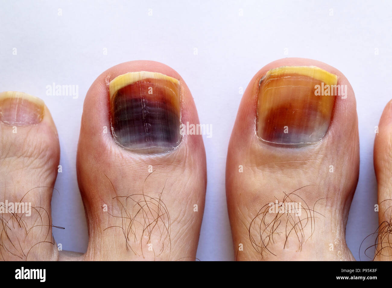Nail Fungus Treatment Gel Restores Discolored Damaged Nails Toenail Care +  | eBay