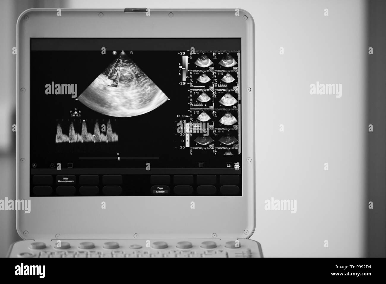 On the screen of an ultrasound machine, a saginal scan of the brain with visualization of the cerebral artery by the Doppler method and measurement of Stock Photo