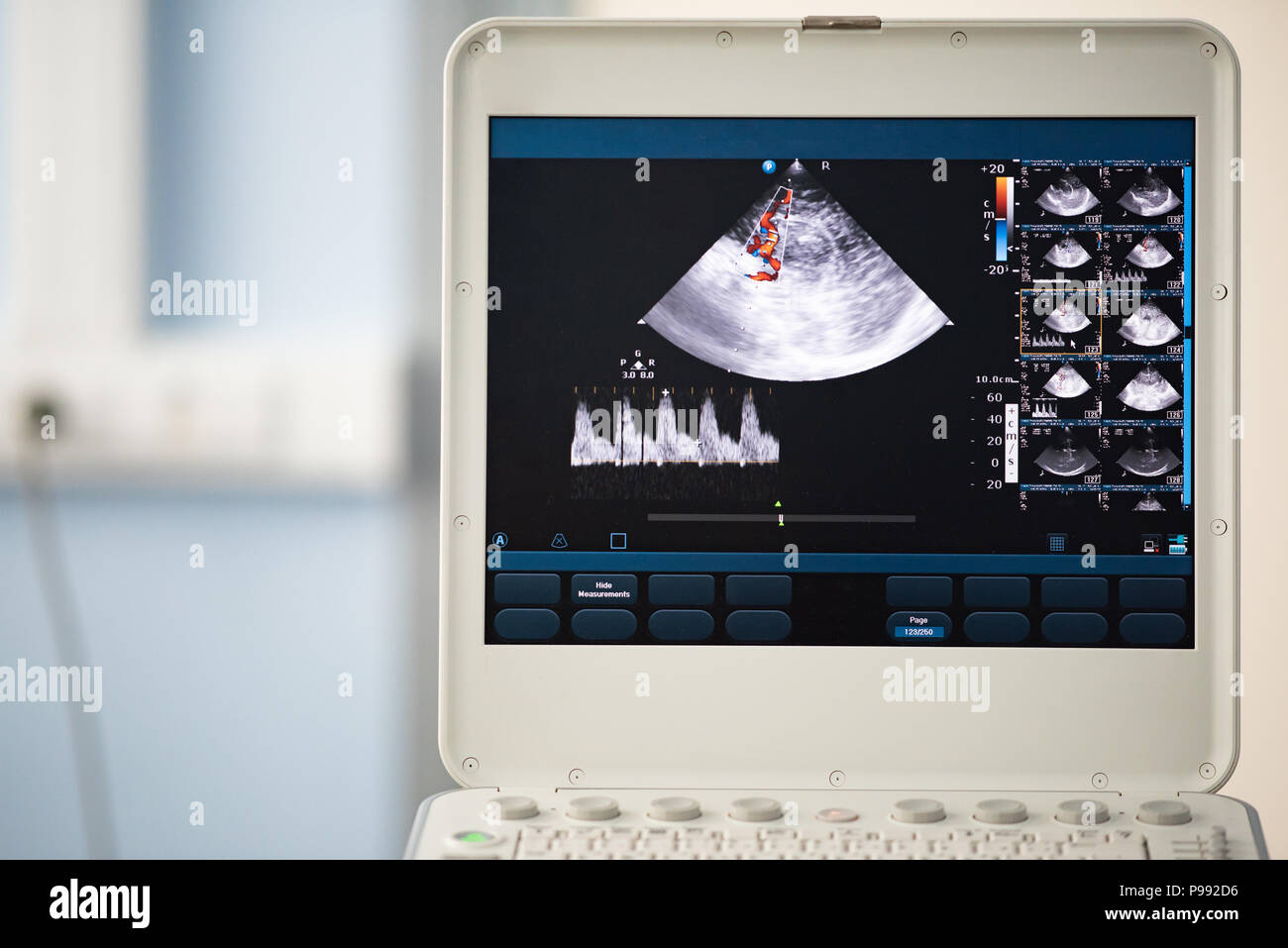 On the screen of an ultrasound machine, a saginal scan of the brain with visualization of the cerebral artery by the Doppler method and measurement of Stock Photo