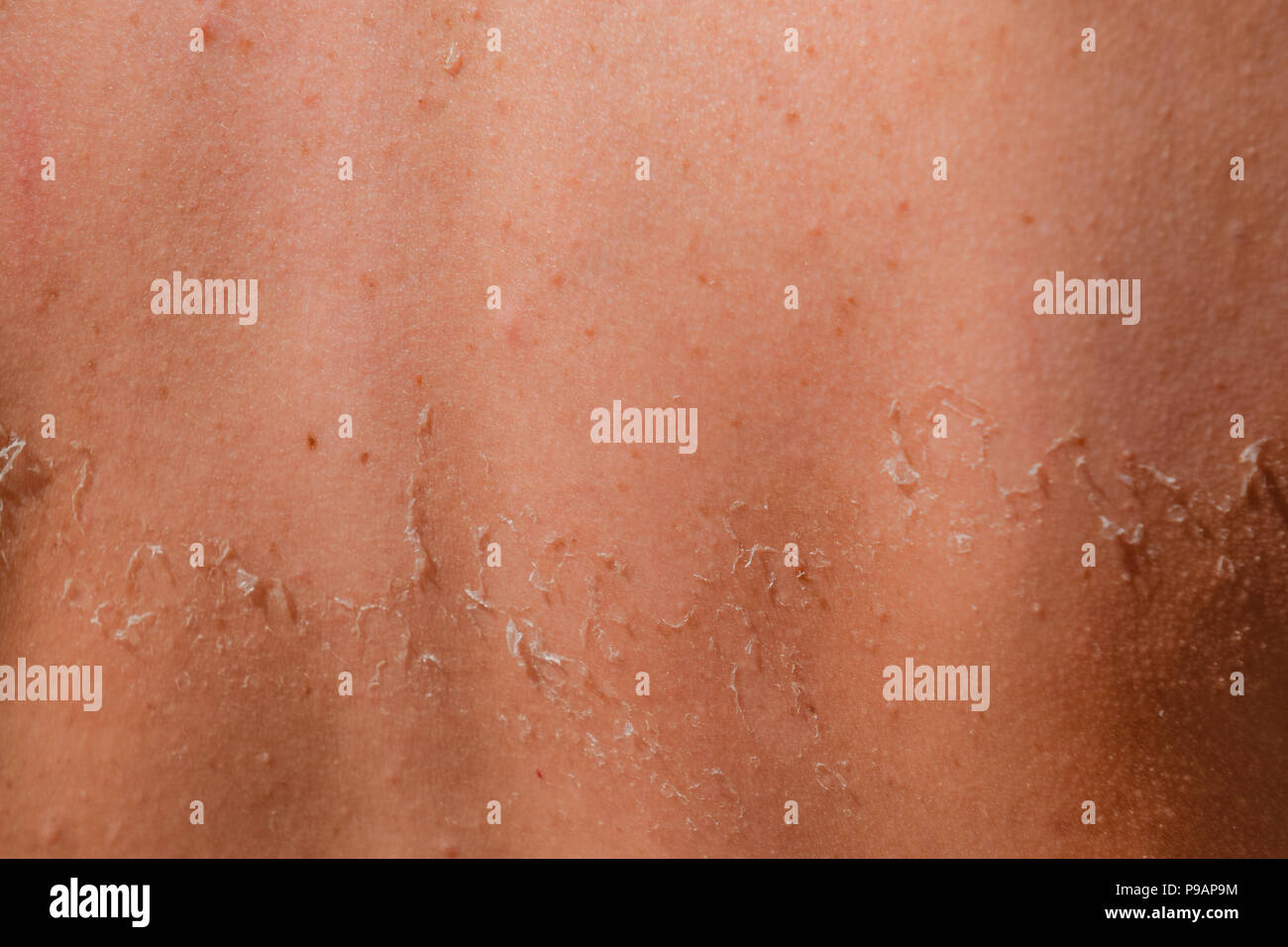 Sunburn on the skin of the back. Exfoliation, skin peels off. Dangerous