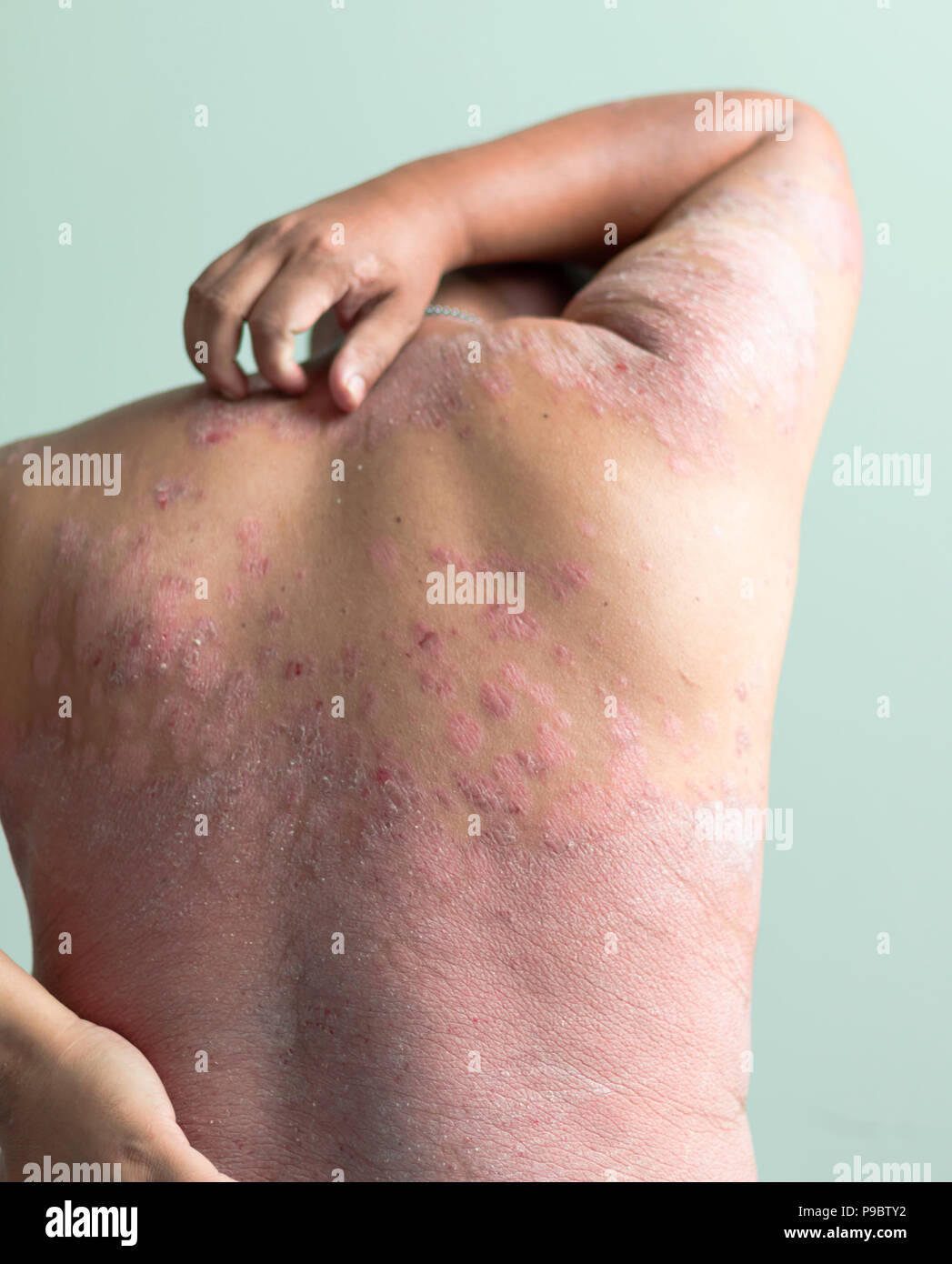 Men use hands to scratch the wound. Diseases caused by abnormalities of the lymph. Psoriasis is a skin disease. Select focus shallow depth of field an Stock Photo