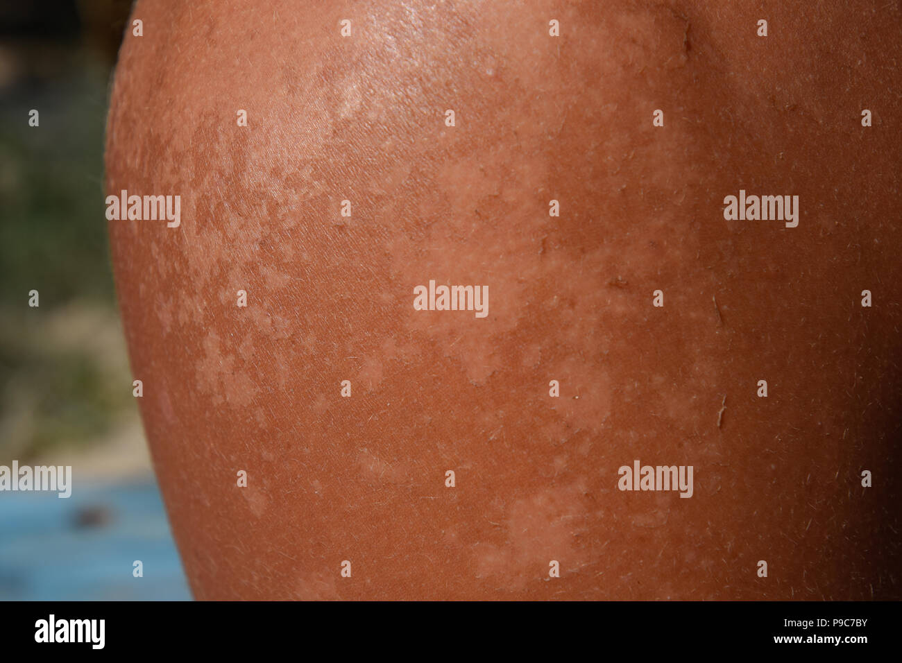 Sunburn on the skin of the shoulders. Exfoliation, skin peels off